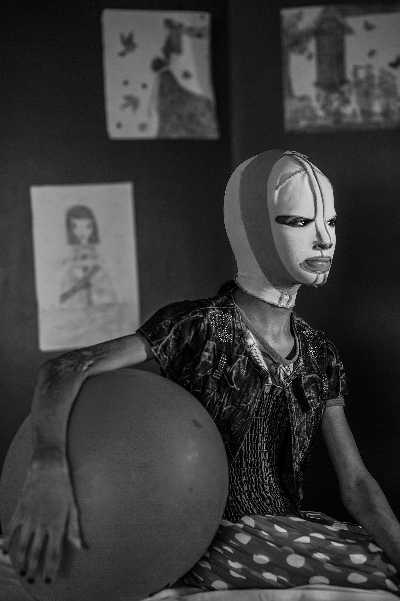 Finalista nella categoria persone, singole. Manal, 11 anni, vittima dell’esplosione di un missile a Kirkuk, in Iraq. Indossa una maschera per diverse ore al giorno per proteggere il suo viso dopo un lungo percorso di chirurgia plastica, all’ospedale Al Mowasah, ad Amman, in Giordania. 10 luglio 2017. - (Alessio Mamo)